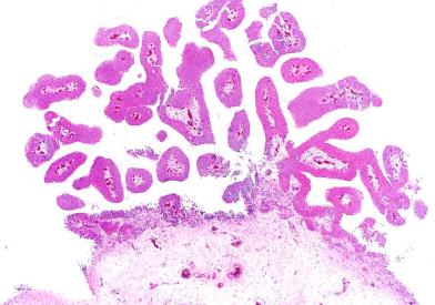 Bladder cancer light micrograph SPL