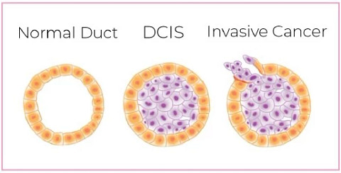 dcis-illustration514x261.jpg
