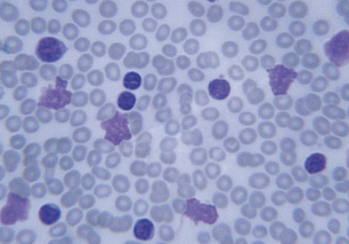 leukemia-cells657x443.jpg