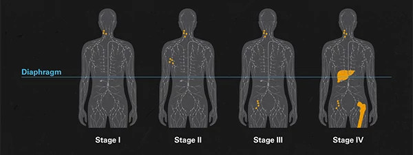 lymphoma-staging-illustration-600x225.jpg