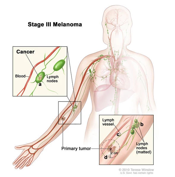 melanoma-stage-iii-diagram590x598.jpg