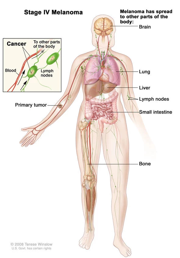 melanoma-stage-iv-diagram590x846.jpg