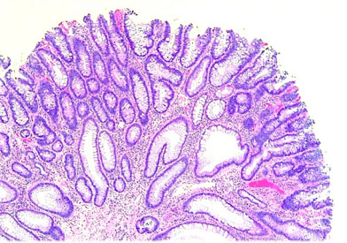 polyp-picture-566x397.jpg